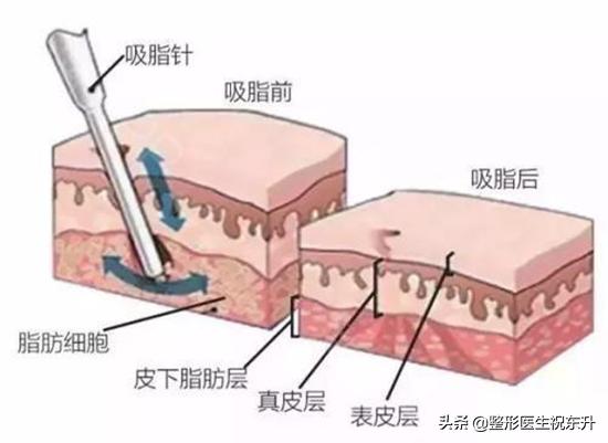 最新吸脂技术，塑造完美身材的革命性方法